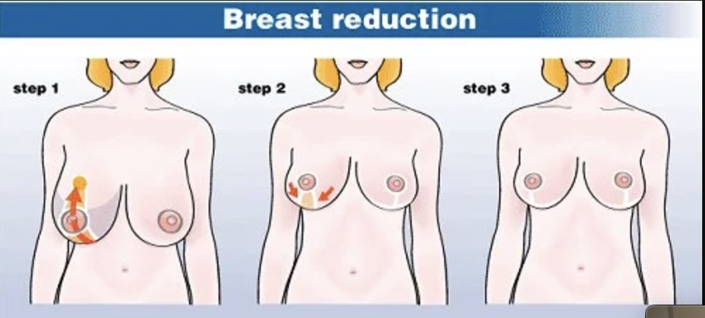 Breast Reduction Procedure